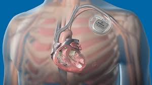 Cardiac Bio Implant Devices Market