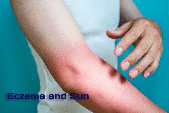 sunburn and eczema