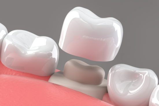 Dental-Crowns-Inner