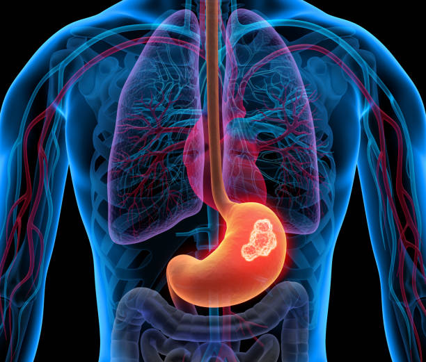 Gastric Cancer