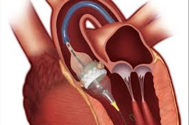 Transcatheter Heart Valve Replacement Market