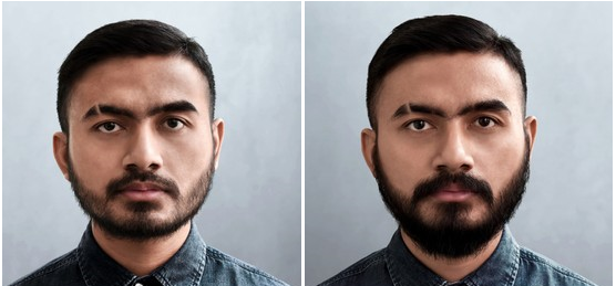 Beard HairTransplant