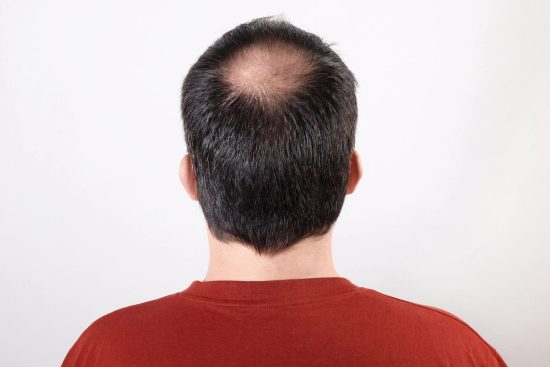 The Ultimate Guide to Crown Hair Transplants for Fuller Hair