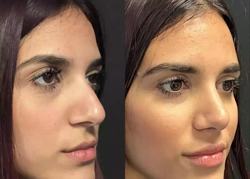 Why Choose the Best Rhinoplasty Surgeon in Dubai for Your Procedure?