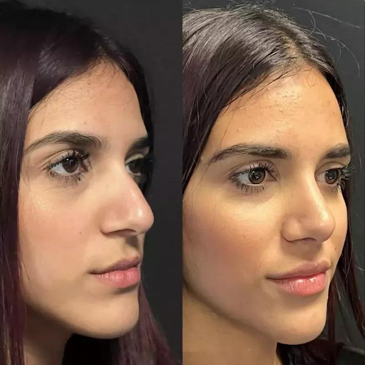 Why Choose the Best Rhinoplasty Surgeon in Dubai for Your Procedure?