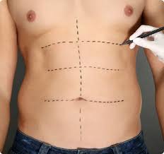 liposuction in Lahore