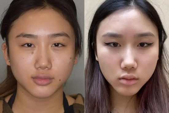 Buccal Fat Removal