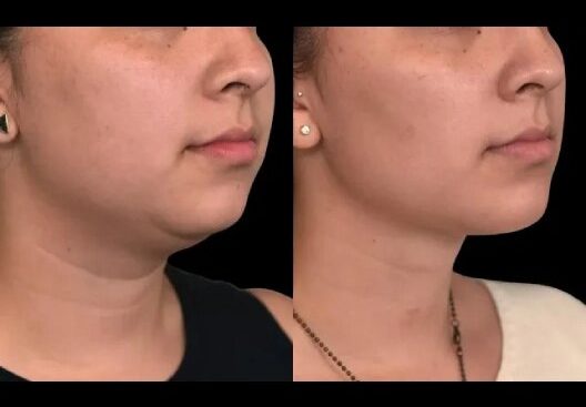 Chin-liposuction-7