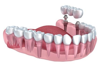 Dental Implants Treatment