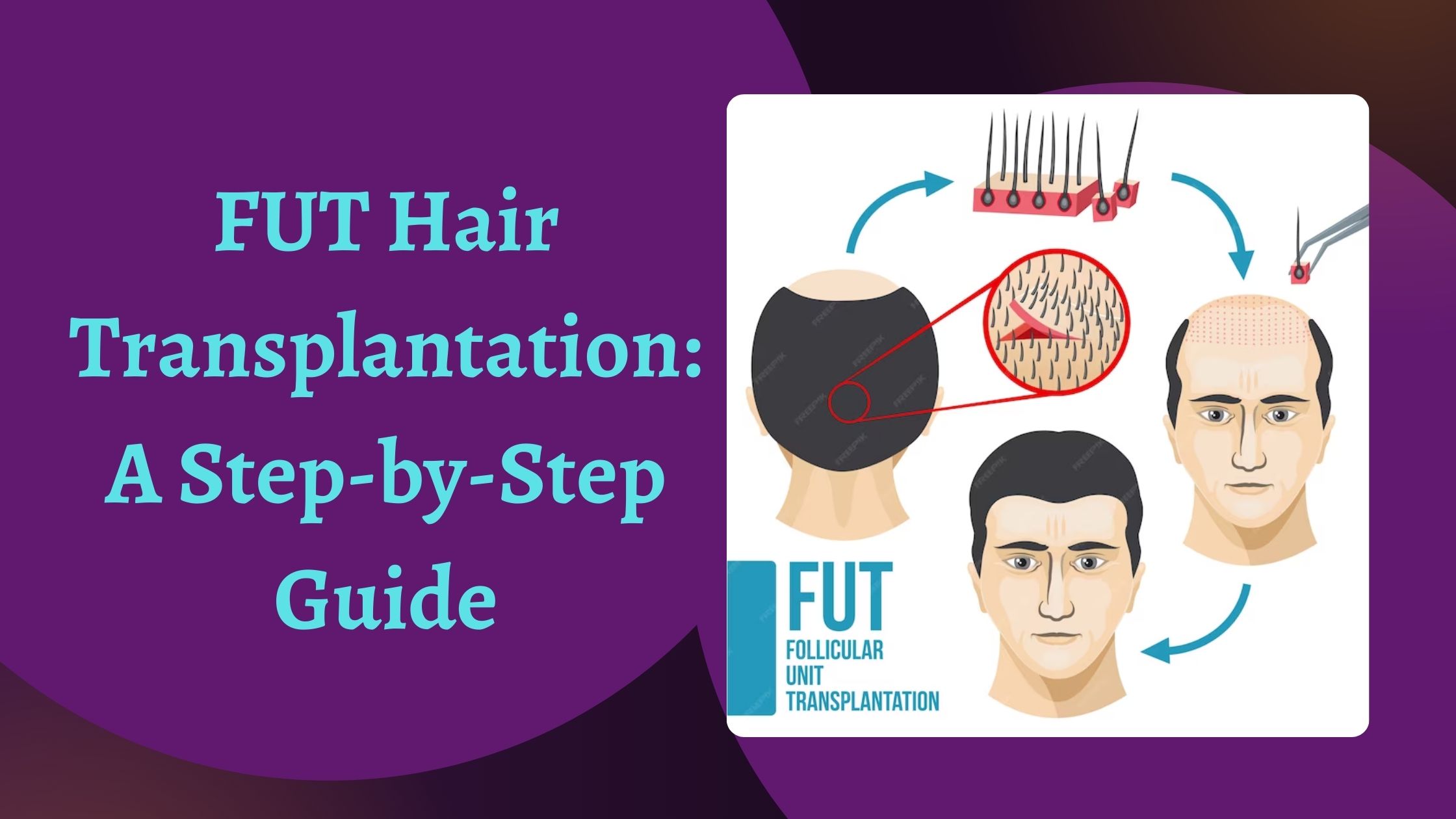 FUT Hair Transplantation A Step-by-Step Guide