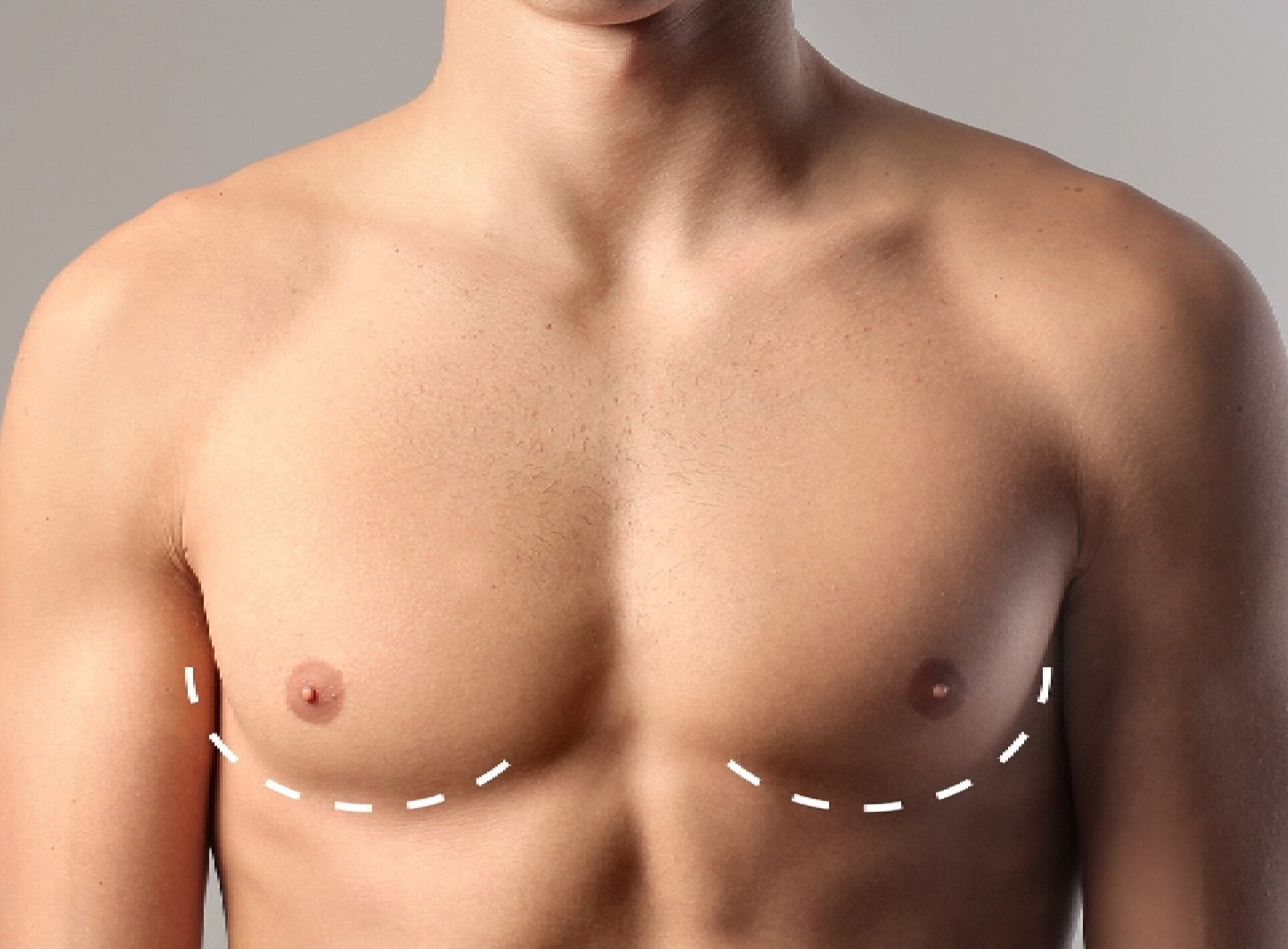 gynecomastia in dubai