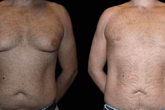 gynecomastia in dubai