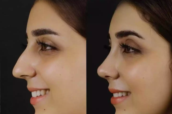 H-Rhinoplasty4-copy