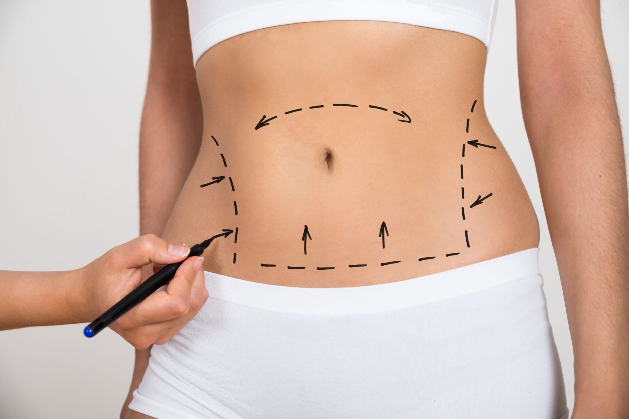 How Liposuction Can Help Redefine Your Body