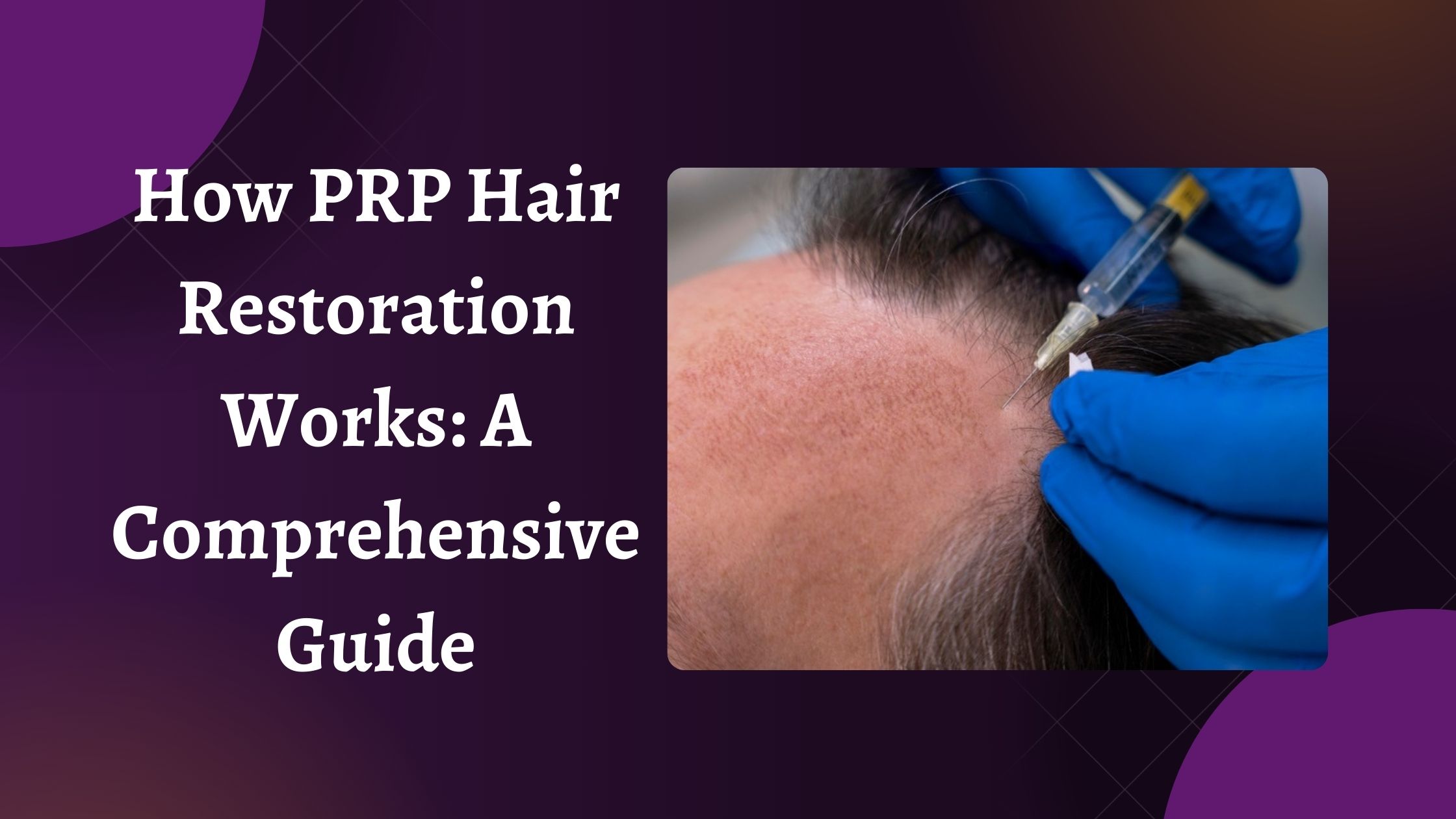 How PRP Hair Restoration Works A Comprehensive Guide