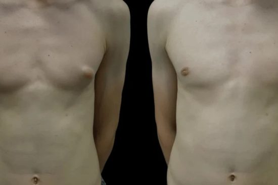 gynecomastiaperfectdoctorsclinic-ezgif.com-webp-to-jpg-converter