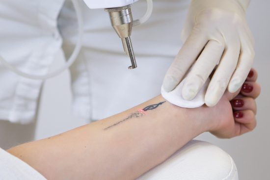 laser-tattoo-removal-dubai-scaled