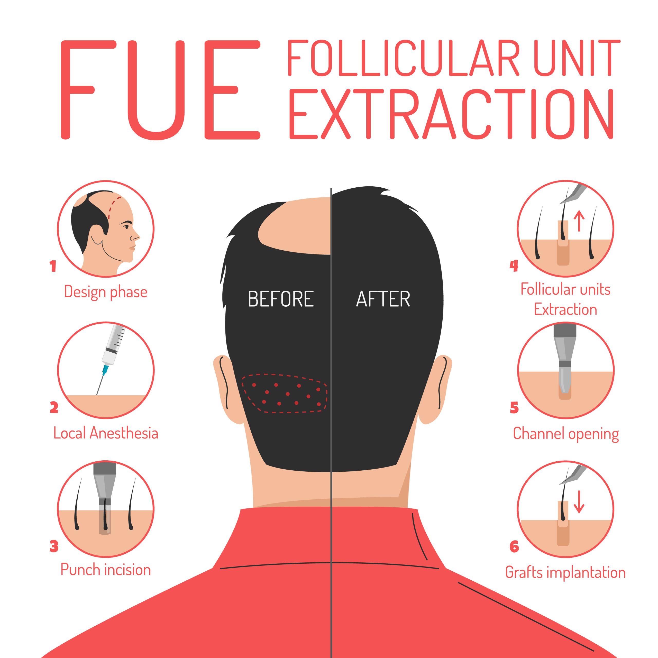 FUE hair transplant