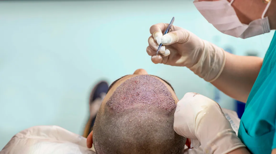 Hair Transplants for Younger Men When Is It the Right Time