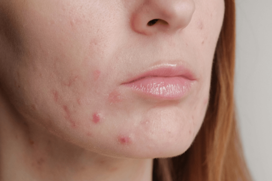 Sensitive Skin and Acne Treatment Tips for Fragile Skin