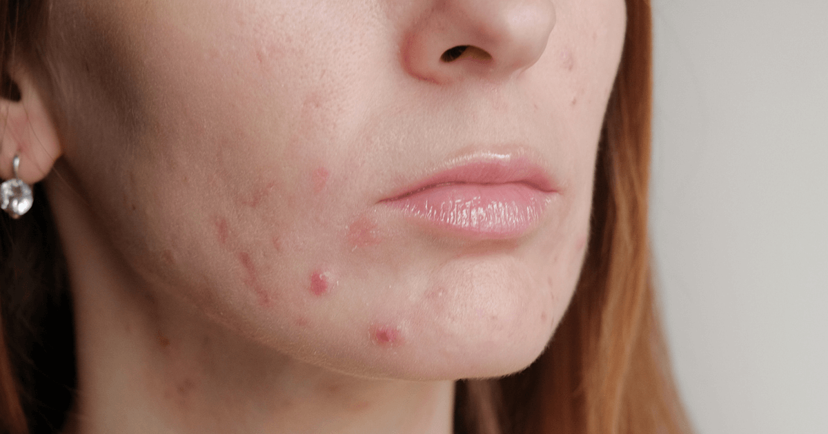 Sensitive Skin and Acne Treatment Tips for Fragile Skin